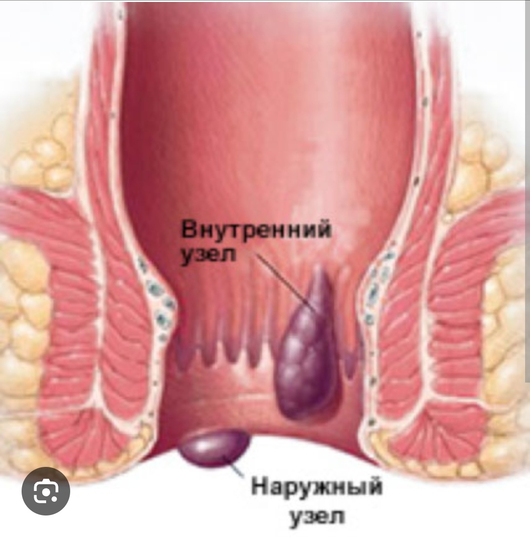 Новые мало инвазивные методы лечения геморроя. Один из них лазерная валоризация узлов. Данный метод малотравматичен и высокоэффективен в опытных руках лазерного хирура. Помимо знания анатомии необходимо понимание принципов воздействия лазерного луча на ткани. Правильно подобранная мощность, режим и длительность воздействия, являются неотъемлимой частью успешно выполненной операции. 