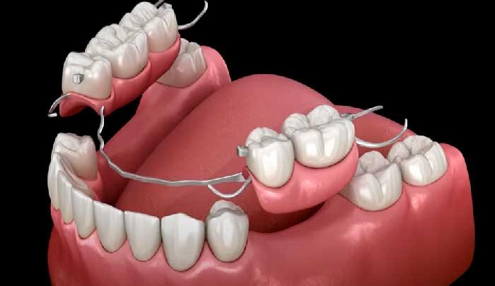 Сколько стоит вернуть потерянные зубы? Современные методы восстановления зубов!