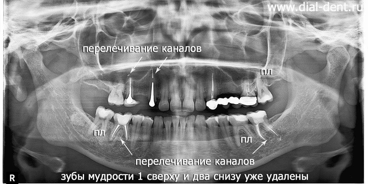 панорамный снимок зубов после удаления зубов мудрости и перед началом комплексного лечения