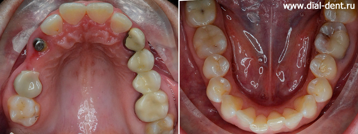 вид зубов до лечения, мостовидный протез на верхней челюсти сломался