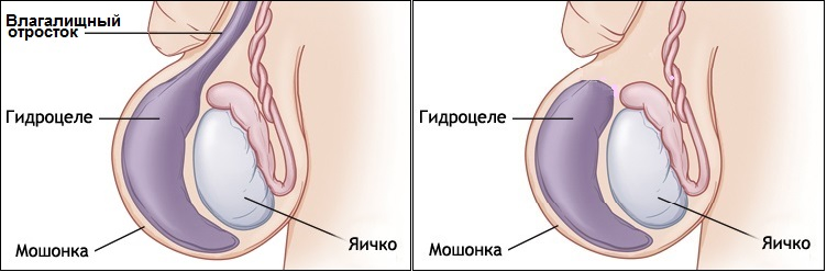 Слева - сообщающаяся форма водянки, а справа - изолированная форма