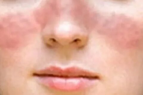 Бабочка при системной красной волчанке.  https://avatars.mds.yandex.net/i?id=cb9fe118703dd69f51ad25c12e312b349a259af0-5318825-images-thumbs&n=13  placerespr.com