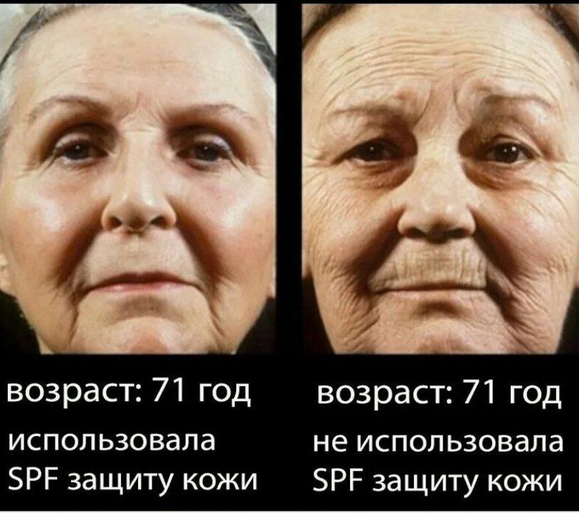 Кожа, поврежденная солнцем, более морщинистая с пигментацией, более тёмная, с шелушениями и обезвоженная.На ощупь местами шершавая, "вялая".Если взять в щипок, то долго расправляется - это признак обезвоженности.