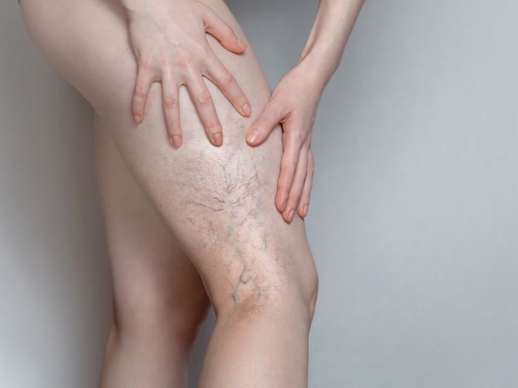 Варикозное расширение вен.