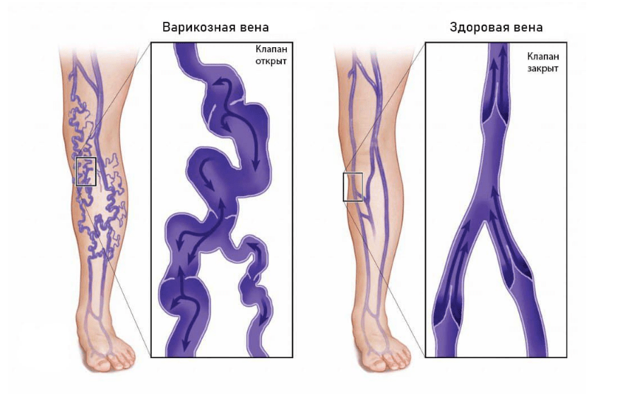 Постепенная трансформация венозной стенки, потеря ее эластичности, ухудшается качество жизни пациента и его окружающих людей ( это если говорить о трофической язве)
