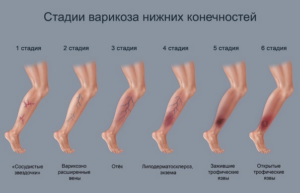 Международная классификация CEAP.