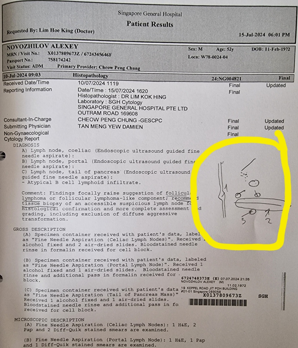 Не-а. Это не рисунок моего ребёнка. Это схематическое описание процесса моей биопсии дипломированным врачом Сингапура.