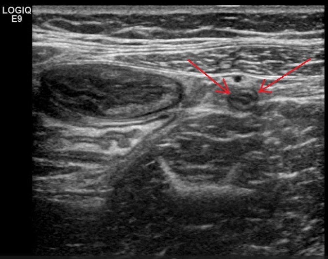 Рис. 01 - Нормальный аппендикс, поперечное изображение