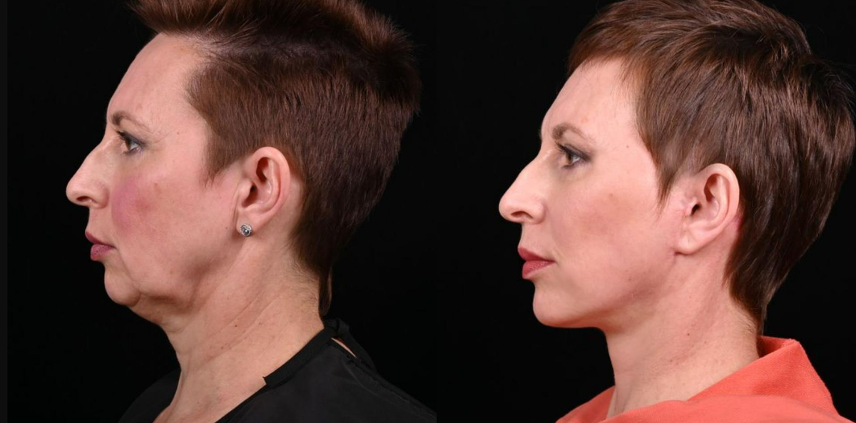 Пластика лица и шеи Macs-lift фото до и после. Фото с сайта хирурга Д.Р. Гришкяна. Имеются противопоказания, требуется консультация специалиста