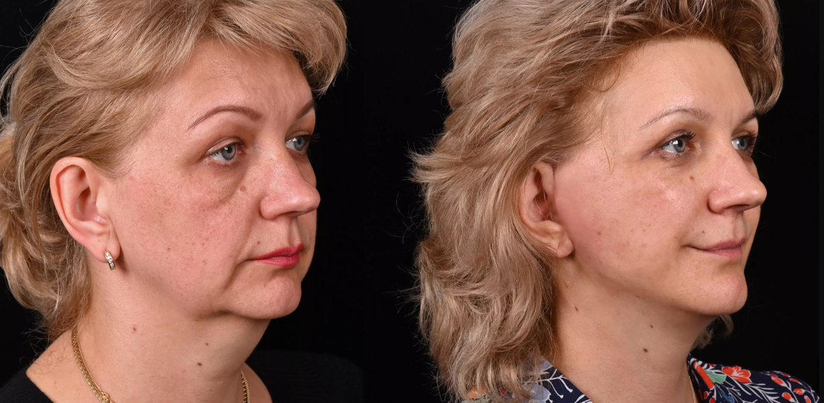 Пластика лица и шеи Macs-lift и липосакция шеи. Фото до и после. Фото с сайта хирурга Д.Р. Гришкяна. Имеются противопоказания, требуется консультация специалиста