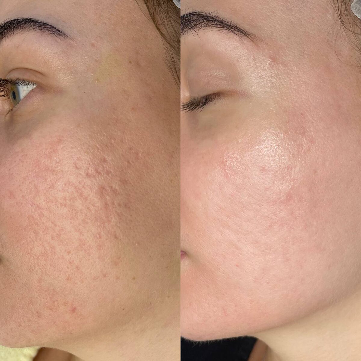 Лазерная шлифовка ZOOM Scan «до/после» в клинике COSMOPRO 