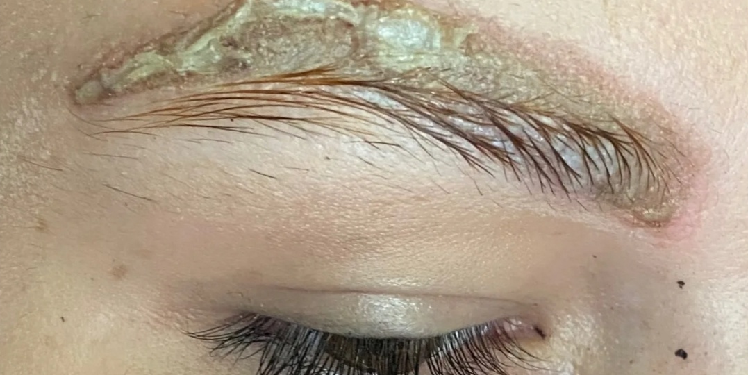 Удаление татуажа ремувером