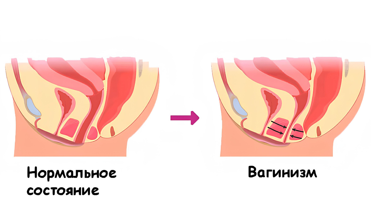 Схема: нормальный тонус мышц тазового дна и спазм при вагинизме
