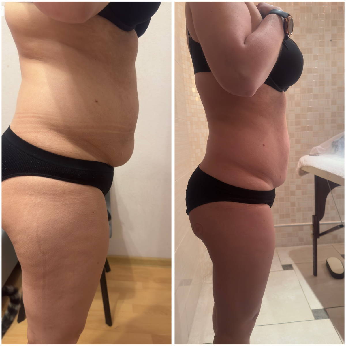 Похудение на антицелюллитном массаже