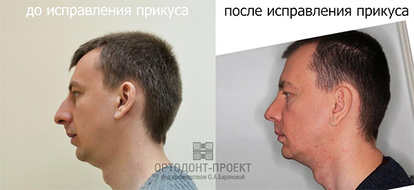 Узкая челюсть до и после брекетов