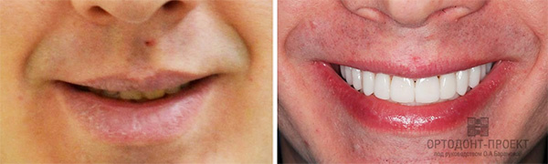 Узкая челюсть до и после брекетов