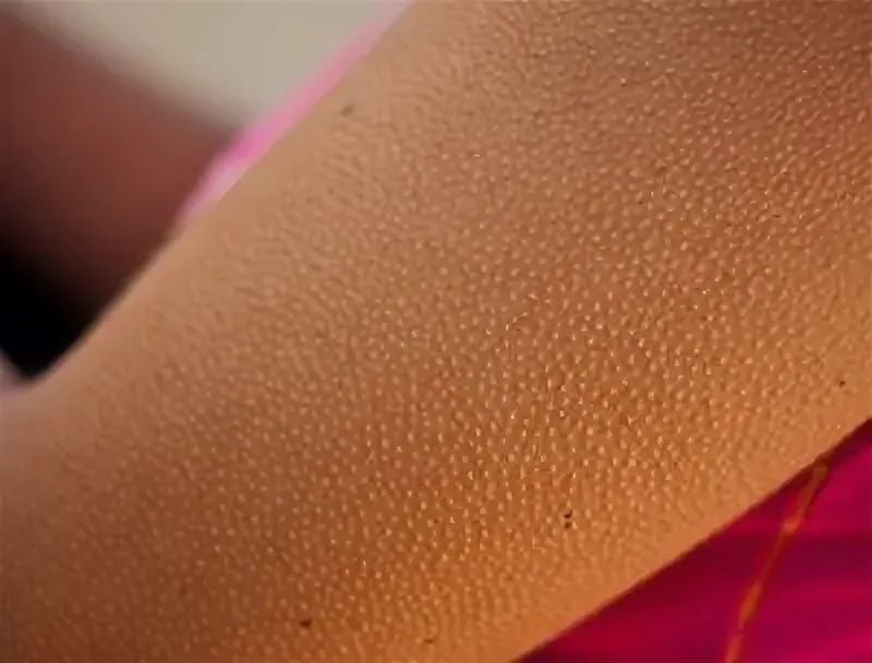 Цитаты про мурашки по коже. Мурашки на коже. У меня уже мурашки. Фолликулярной кератозп. Мурашки афоризмы.