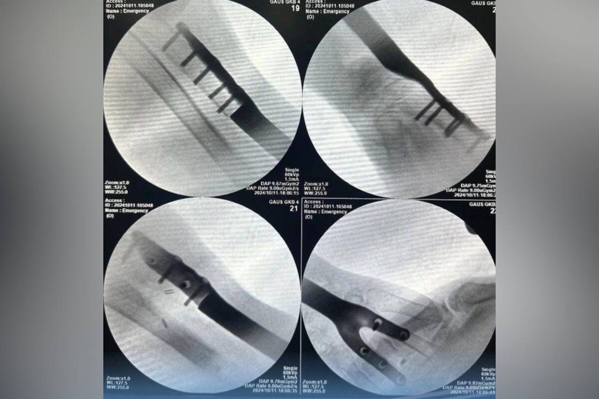    В Оренбурге 72-летней пенсионерке после нападения собаки установили имплант в руку