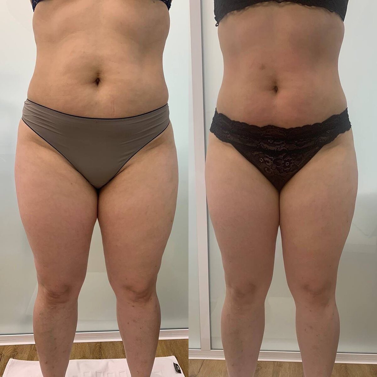 Результат после курса процедур Эндосфера в клинике COSMOPRO  