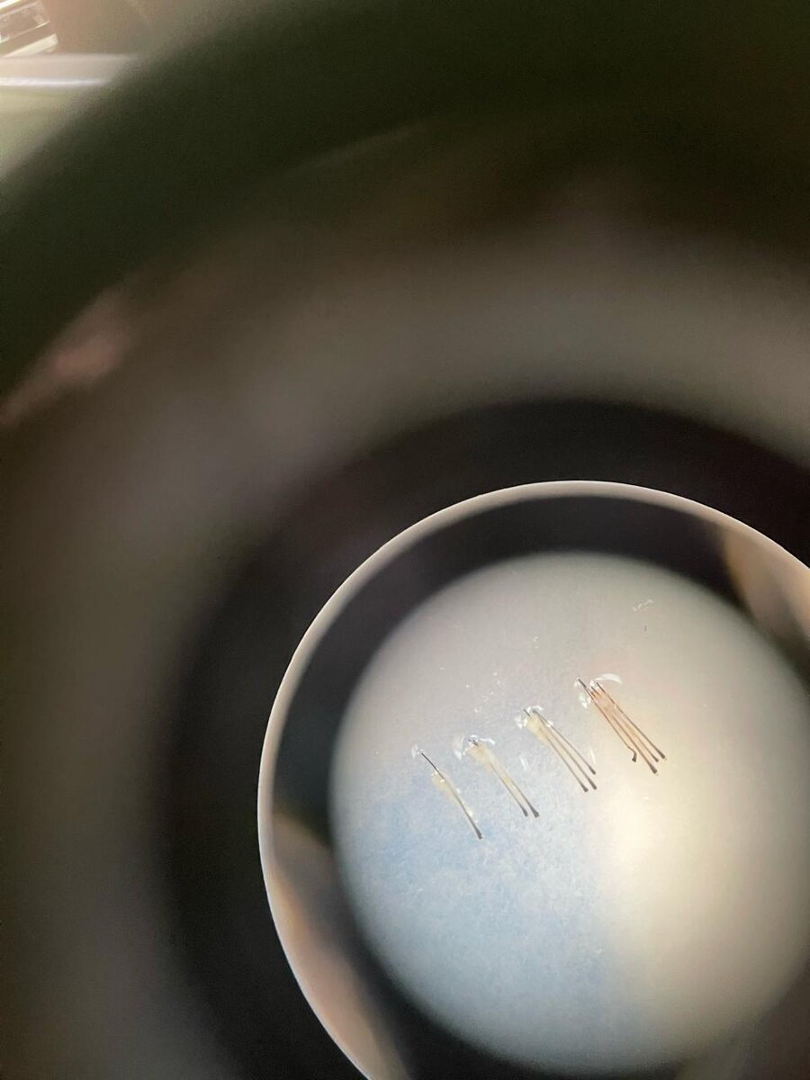 Риск возникновения гнездной алопеции в течение жизни составляет 1,45-2,18%, поэтому мы можем говорить о распространености заболевания. Она поражает как детей, так и взрослых обоих полов, причем пик заболеваемости приходится на второе и третье десятилетия жизни, и у большинства пациентов заболевание дебютирует до четвертого десятилетия.  Следующие факторы могут увеличить риск развития очаговой алопеции:

- Хромосомные нарушения, такие как синдром Дауна
- Полигландулярный аутоиммунный синдром 1-го типа
- Другие аутоиммунные заболевания, например витилиго и аутоиммунные заболевания щитовидной железы
- Семейный анамнез гнездной алопеции, генетическая предрасположенность
- Вирусная инфекция 
- Травма в месте очага
- Физический или эмоциональный стресс

Очаговая алопеция обычно диагностируется по клиническим признакам, однако для уточнения врач может использовать и специальные методы для оценки причины выпадения волос. Так, при трихоскопии (осмотре волосистой части кожи головы с помощью увеличительного прибора) выявляются волосы в виде восклицательного знака, сломанные волосы, а также желтые и черные точки, характерные для очаговой алопеции. Отмечается положительный результат пулл-теста, при котором врач берет 40–60 близко расположенных волос и осторожно вытягивает их: при этом выпадает более 5-6 волос. Может проводиться биопсия с последующим гистологическим исследованием, однако лишь в самых сложных и неоднозначных случаях. 
Главный вопрос, интересующий всех пациентов с очаговой алопецией: можно ли вернуть волосы при этой аутоиммунной патологии?
Отличной новостью является то, что может произойти спонтанное выздоровление и возвращение роста волос. Например, вероятность самопроизвольной ремиссии при гнездной алопеции составляет 1/3 – в течение 6 месяцев, 1/2 - в течение 1 года и 2/3- в течение 5 лет.
