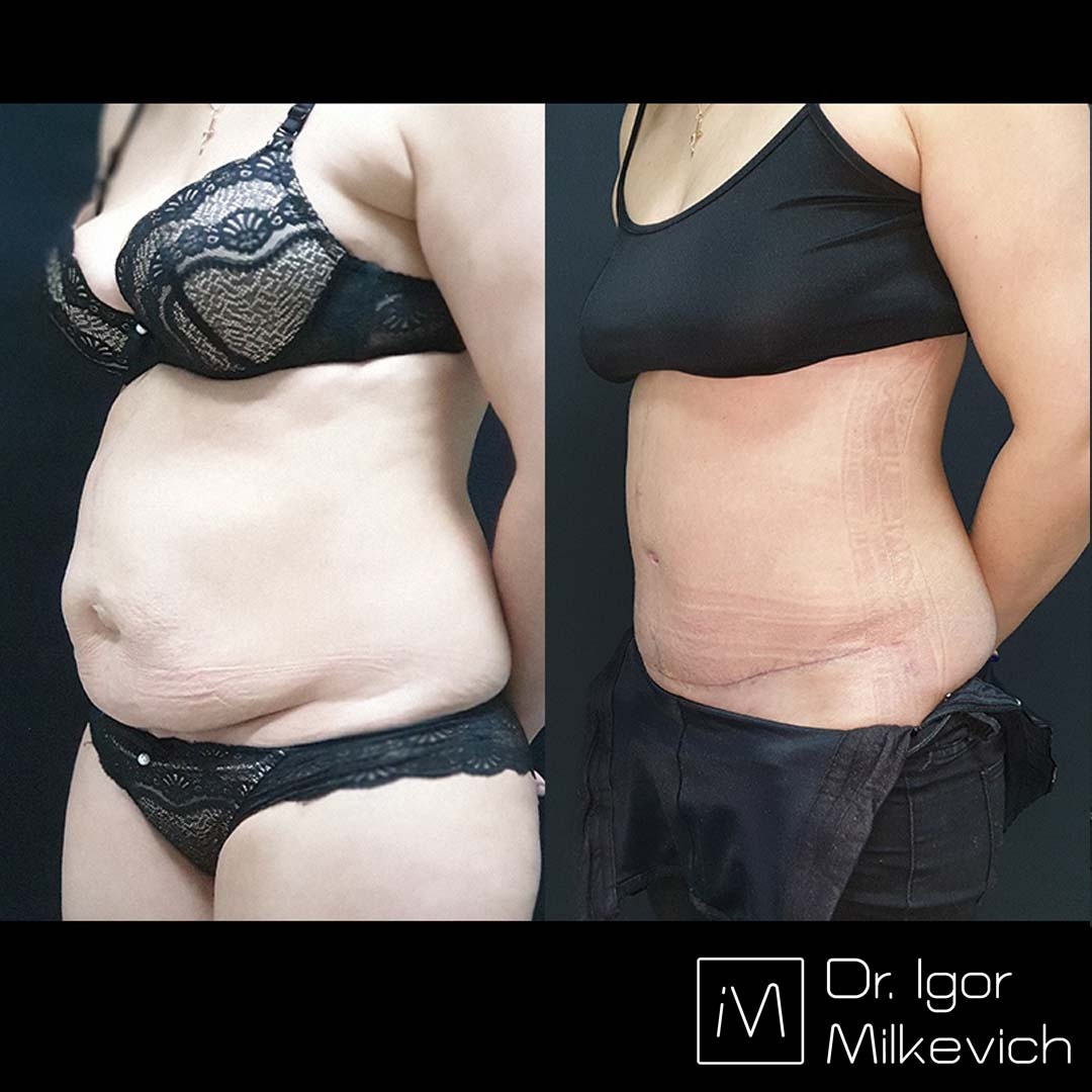 1 месяц после абдоминопластики