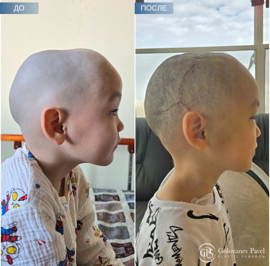 Сагиттальный синостоз 