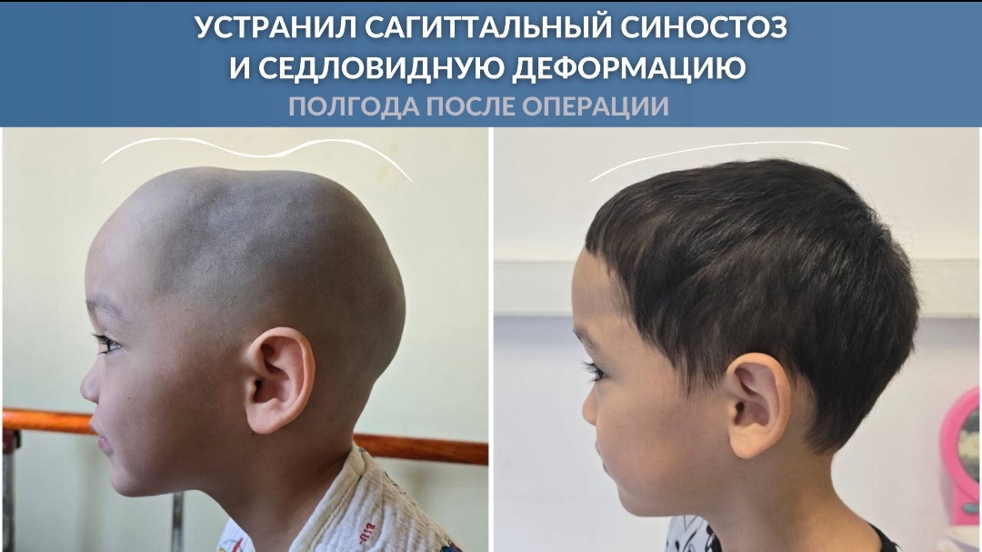 Сагиттальный синостоз 