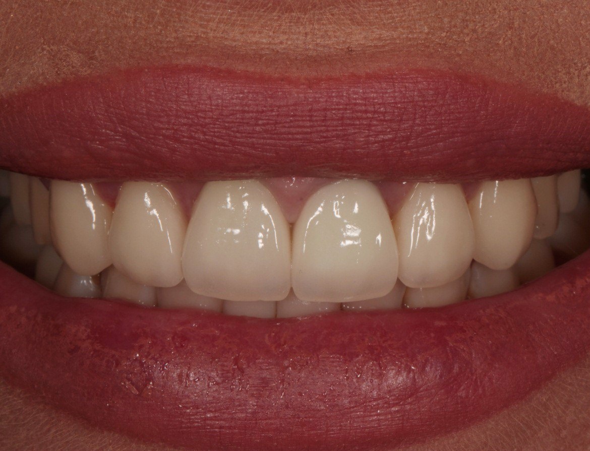 Эстетическая реабилитация зубов с помощью цельнокерамических виниров - одно из основных направлений работы наших стоматологов-ортопедов.