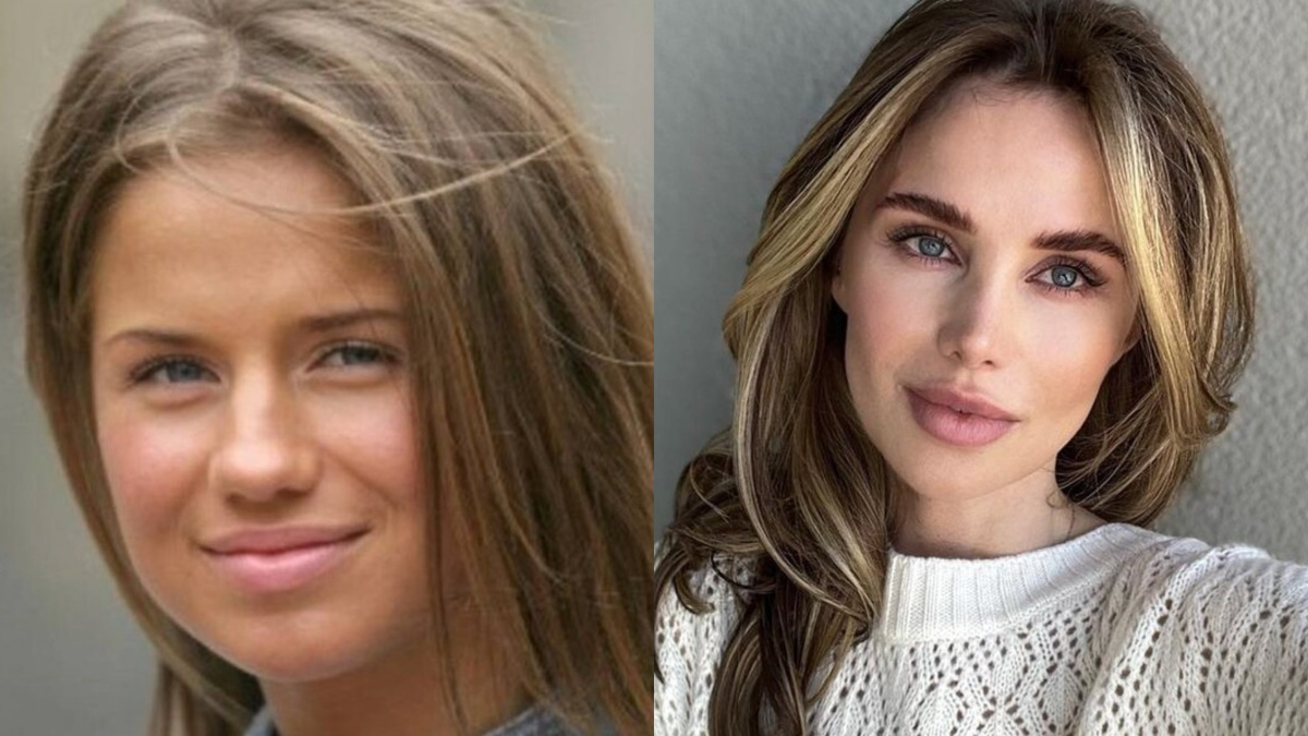 Алекса до и после пластики