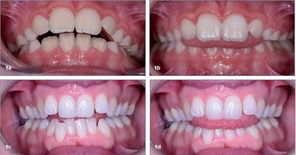  Рис. 1a–d. Открытый прикус, обусловленный неправильным положением языка, проявившийся в детстве и сохранявшийся до взрослого возраста
