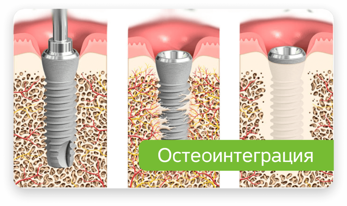 Сращение имплантата с костью