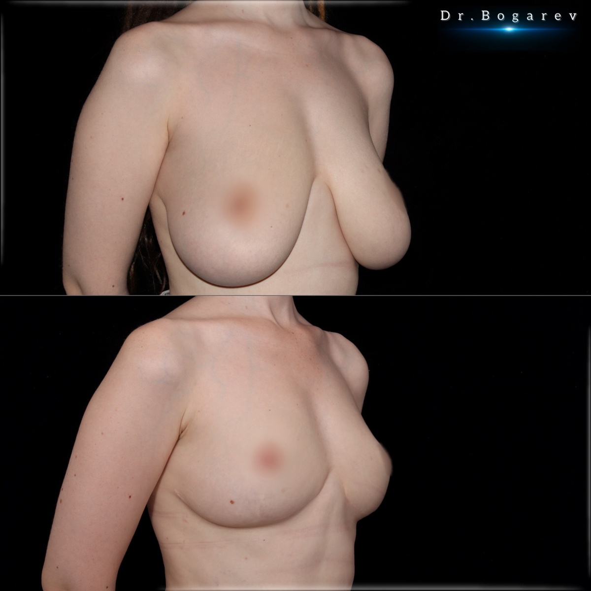 Результат уменьшения молочных желёз через 1,5 года. Врач-пластический хирург Александр Богарев