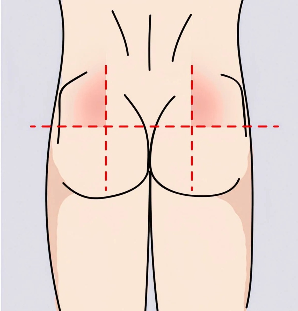 Верхний наружный квадрант ягодицы
