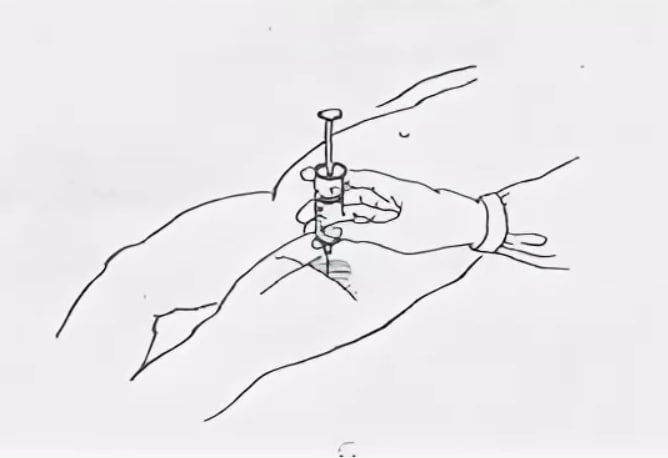 Передненаружная поверхность бедра 