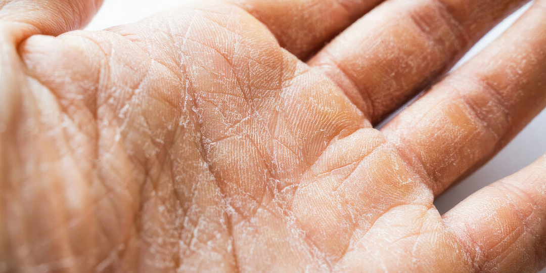 Способы борьбы с сухой кожей рук