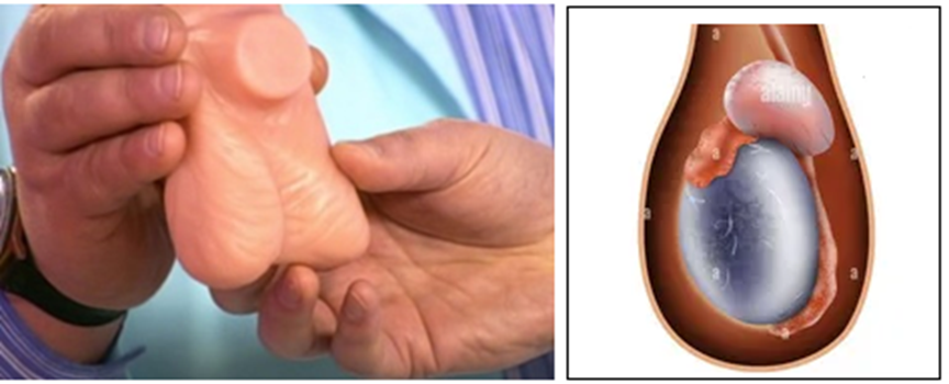 Вот так пальпируют кисту придатка яичка