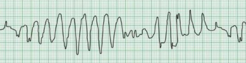 Torsades de pointes (пируэтная желудочковая тахикардия). Комплексы на ЭКГ постоянно меняют амплитуду