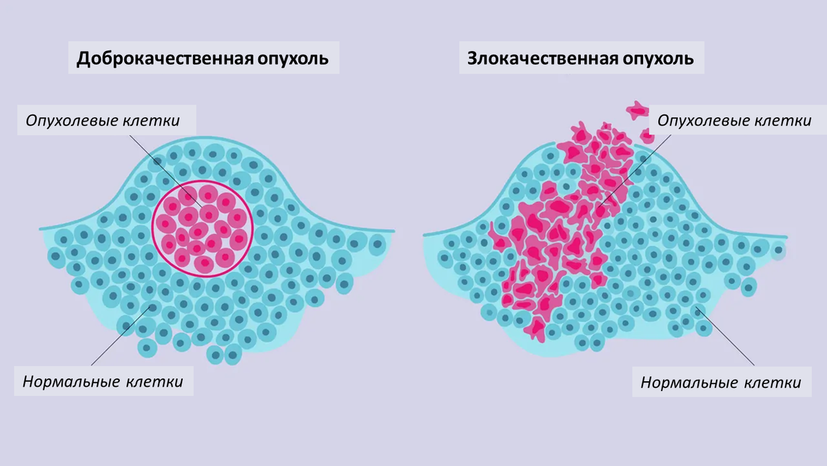 Принципы экспансивного и инвазивного роста ДОБРОкачественных и ЗЛОкачественных опухолей
