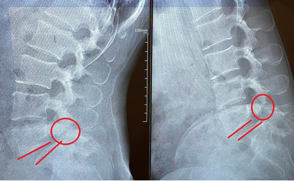 Нестабильный листез на фоне спондилолиза.