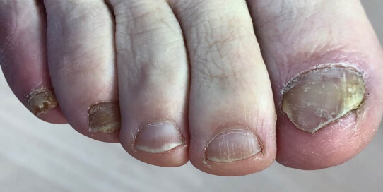 Грибок ногтей
