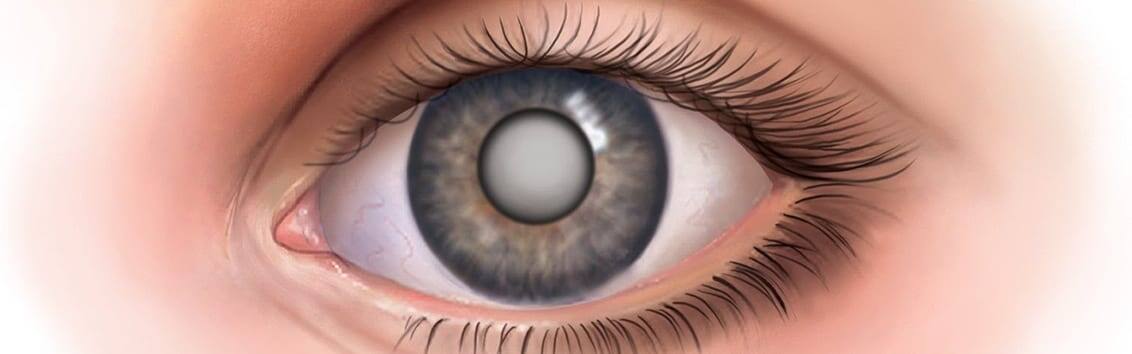 Схематичное изображение глаза с катарактой.