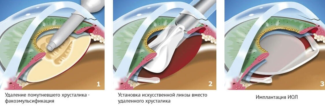 Процесс факоэмульсификации. (Источник: mgkl.ru)