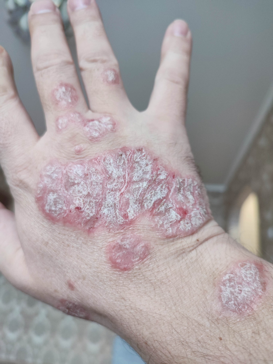 До лечения.