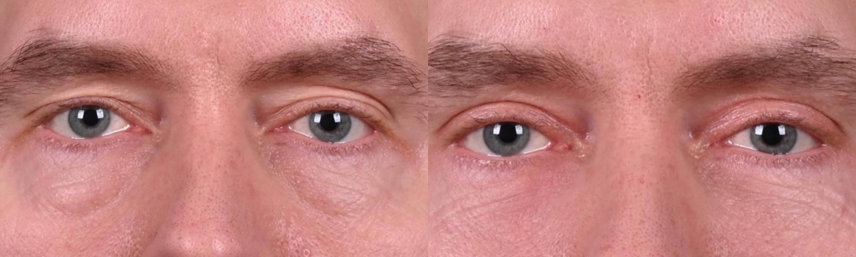 Пластика верхних век фото до и после. Фото с сайта хирурга Д.Р. Гришкяна. Имеются противопоказания, требуется консультация специалиста