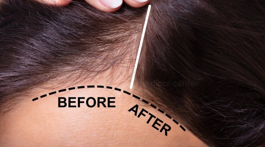 Послеродовое выпадение волос