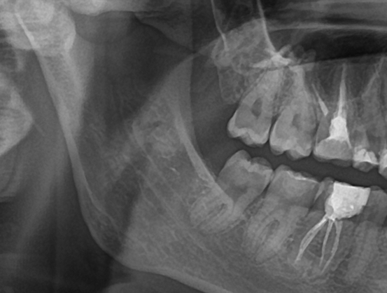 Тот случай, когда в челюсти достаточно места и зубы мудрости стоят в зубном ряду на своем месте