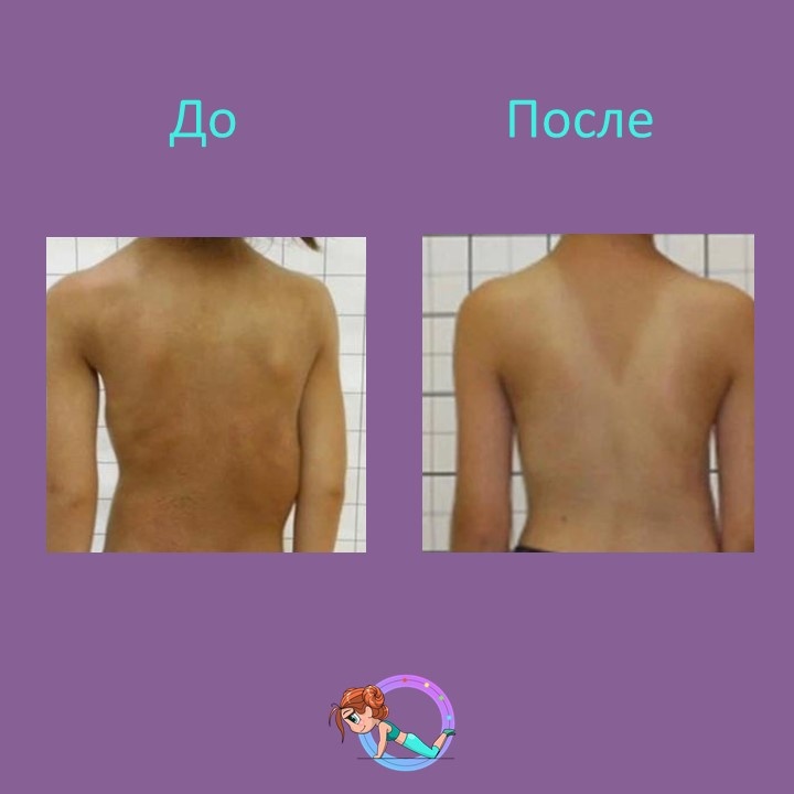 Пациентка М., 2011 г.р., обратилась к ортопеду к.м.н. Громову И.С. с жалобами на деформацию позвоночника.  
По результатам осмотра был поставлен диагноз: юношеский идиопатический сколиоз четвертой степени.

Прошли лечение по методу Шено с корсетотерапией. Результаты впечатляют! 

🔹 Угол деформации в корсете уменьшился с 44° до 16° 
🔹 Коррекция составила более 70% 
🔹 Отличный косметический результат

Действуйте и верьте в чудеса медицины!
