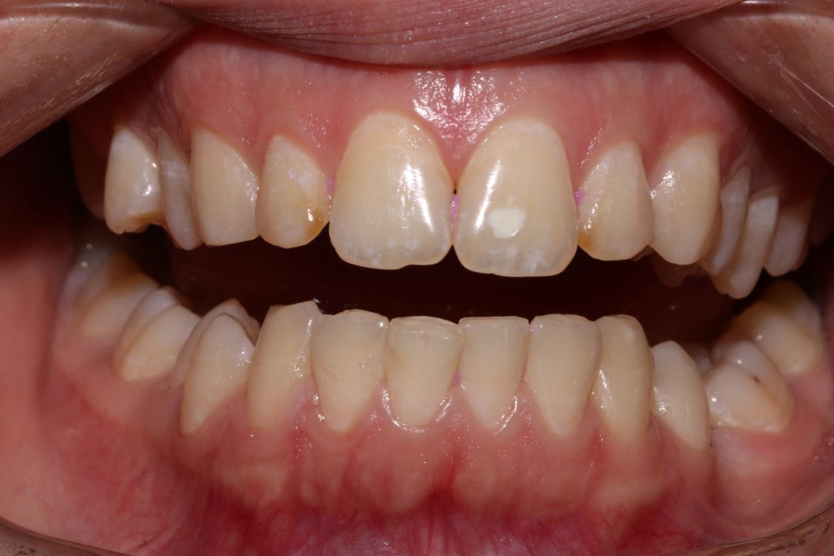 Как правило, патология начинается с появлением белесых пятен на эмали.