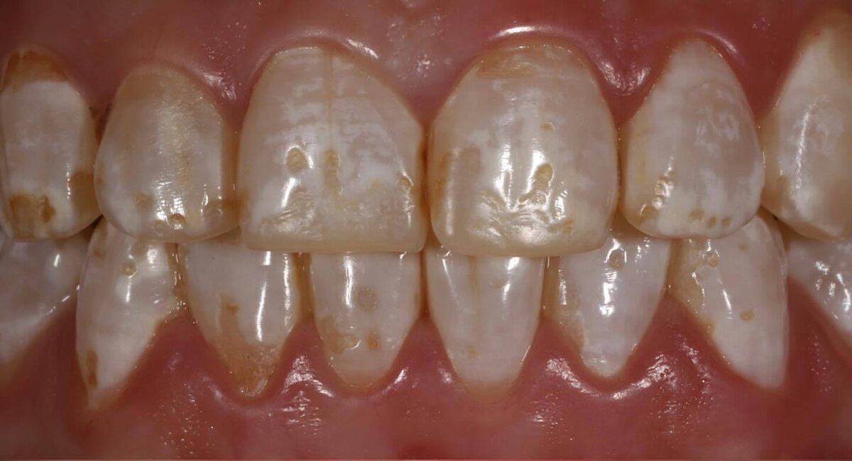 Пациент клиники ПРАЙМ с флоюрозом.