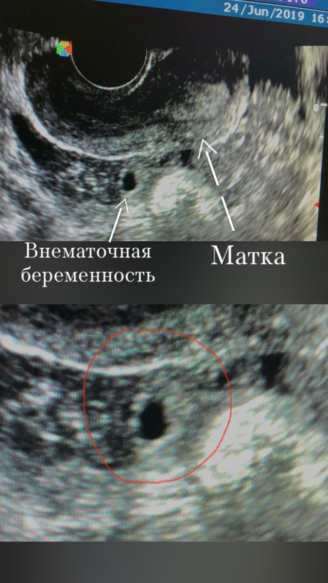 УЗИ внематочной беременности 
